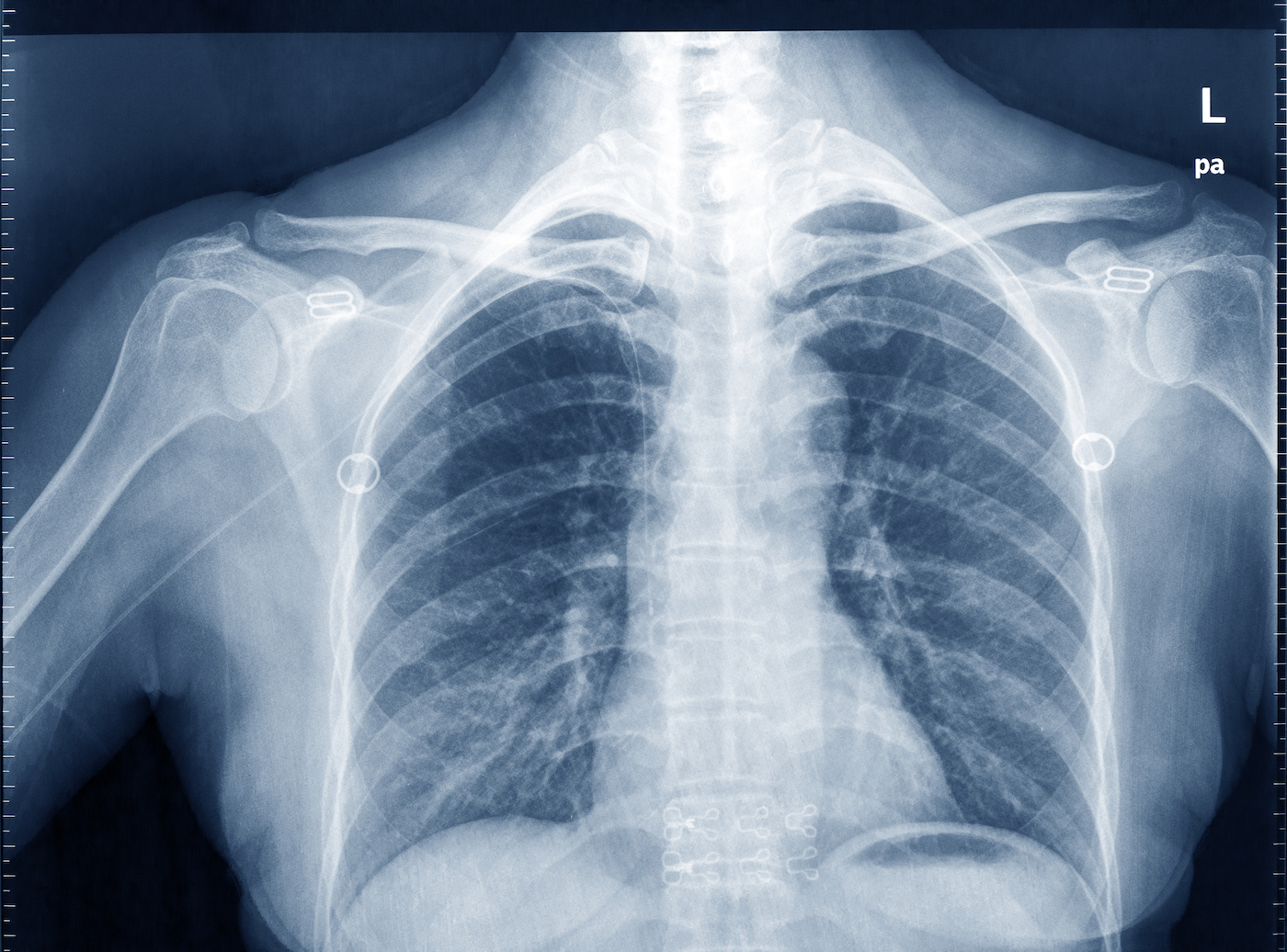How AI Could Predict Heart Disease From Chest X-Rays