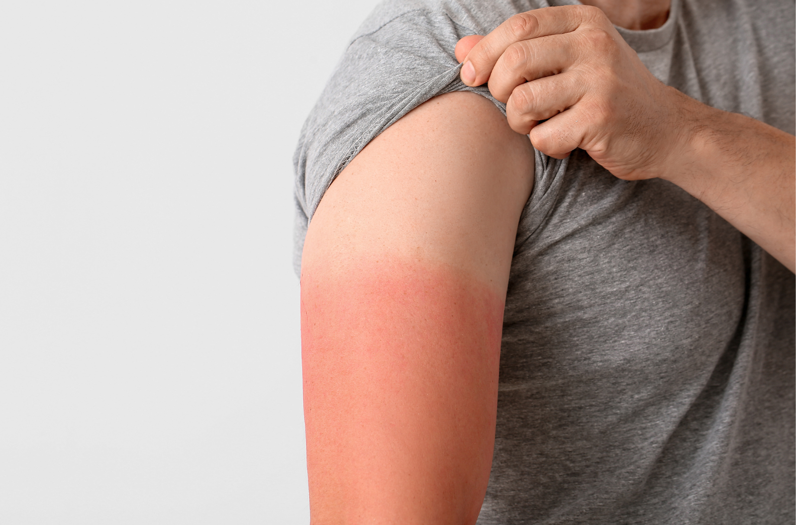 A man’s arm with the skin sunburned on the lower half.