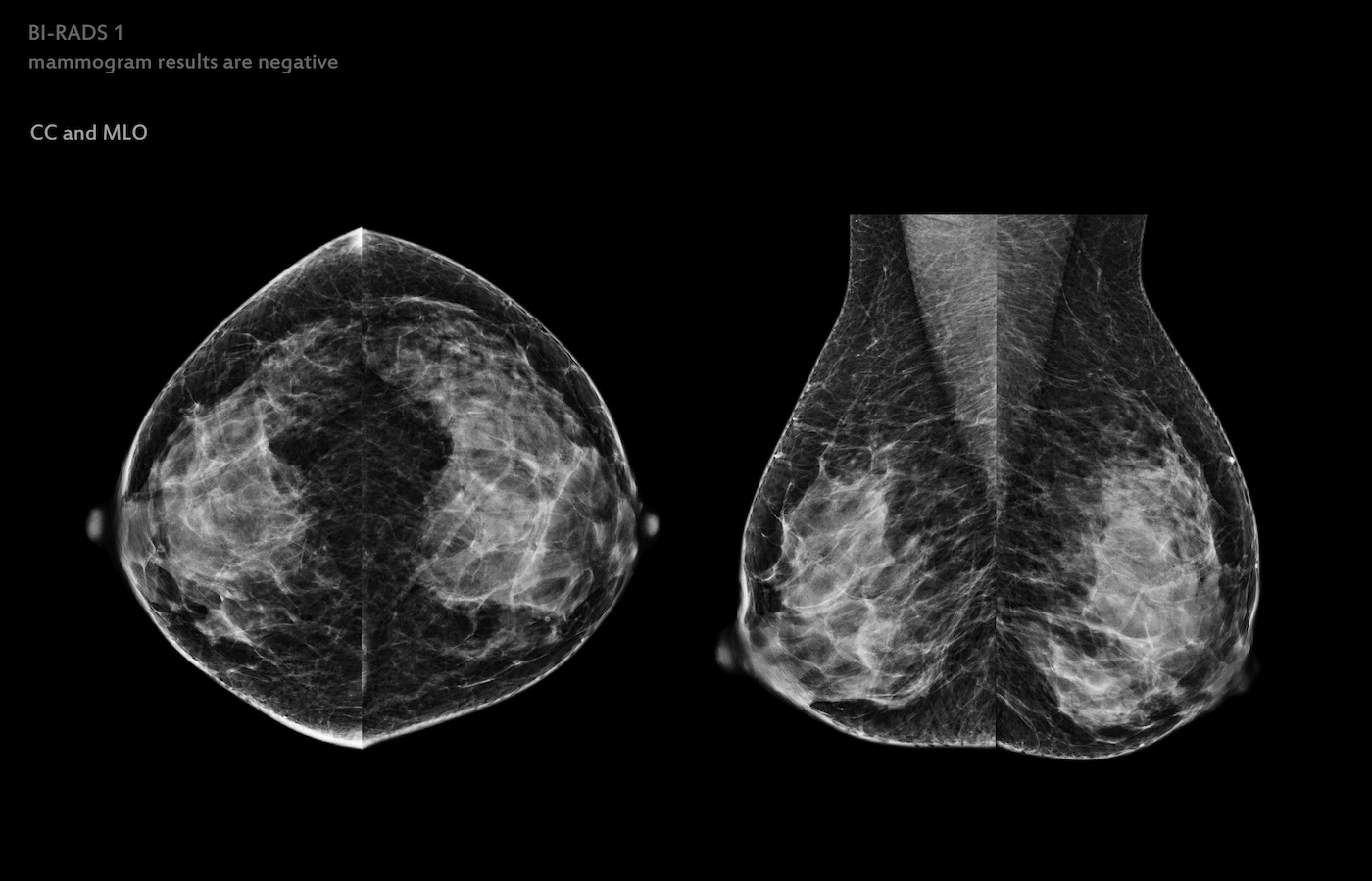 X-ray Digital Mammogram of Both side CC view and MLO view. mammography or breast scan for Breast cancer BI-RADS 1 mammogram results are negative.